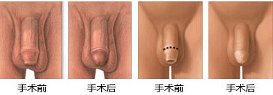 包皮过长技术