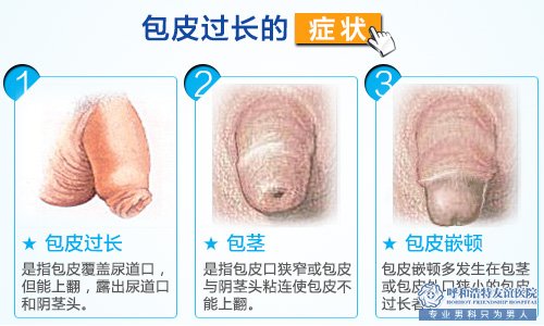 包皮切除后穿着注意事项
